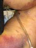 chest tube and bruise1.JPG