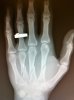 hand X-ray.jpeg