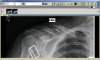 fcuking_clavicle.jpg