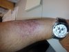 Poison Oak Rash.jpg